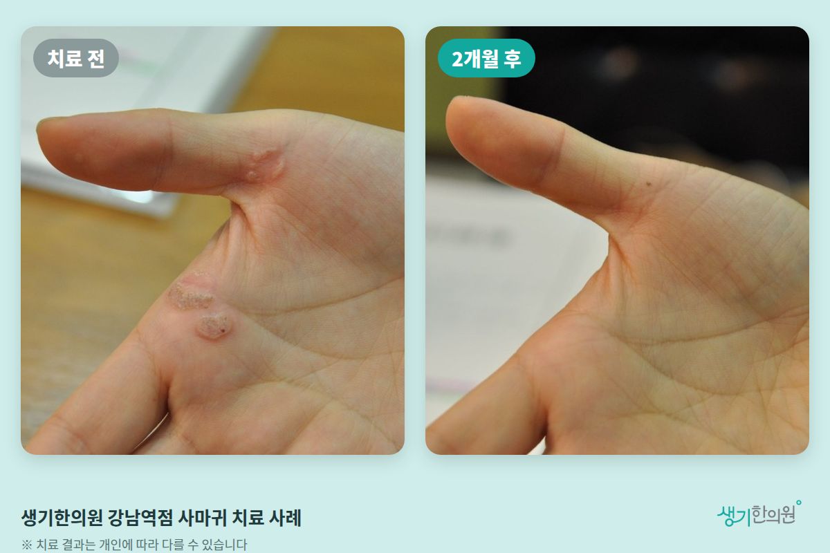 생기한의원 강남역점 사마귀 치료 전과 2개월 후 비교 사진