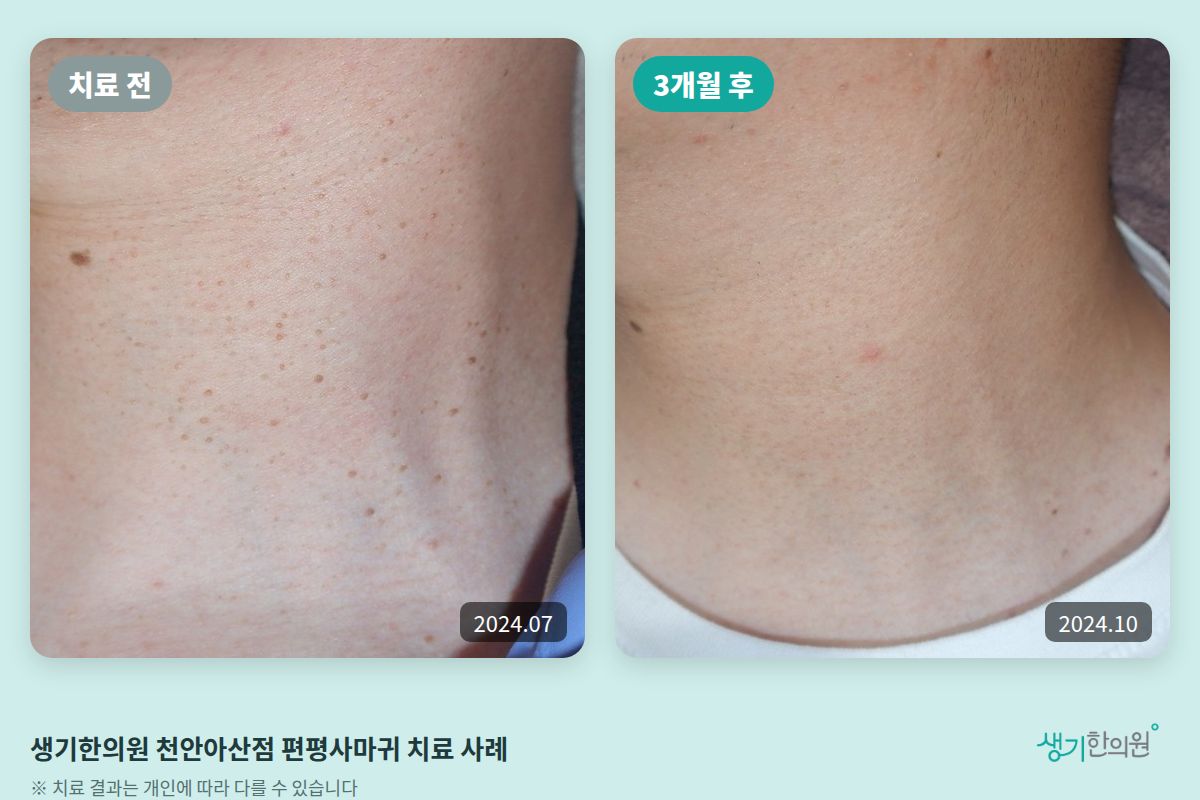 생기한의원 천안아산점 편평사마귀 치료 전(2024.07)과 3개월 후(2024.10) 비교 사진