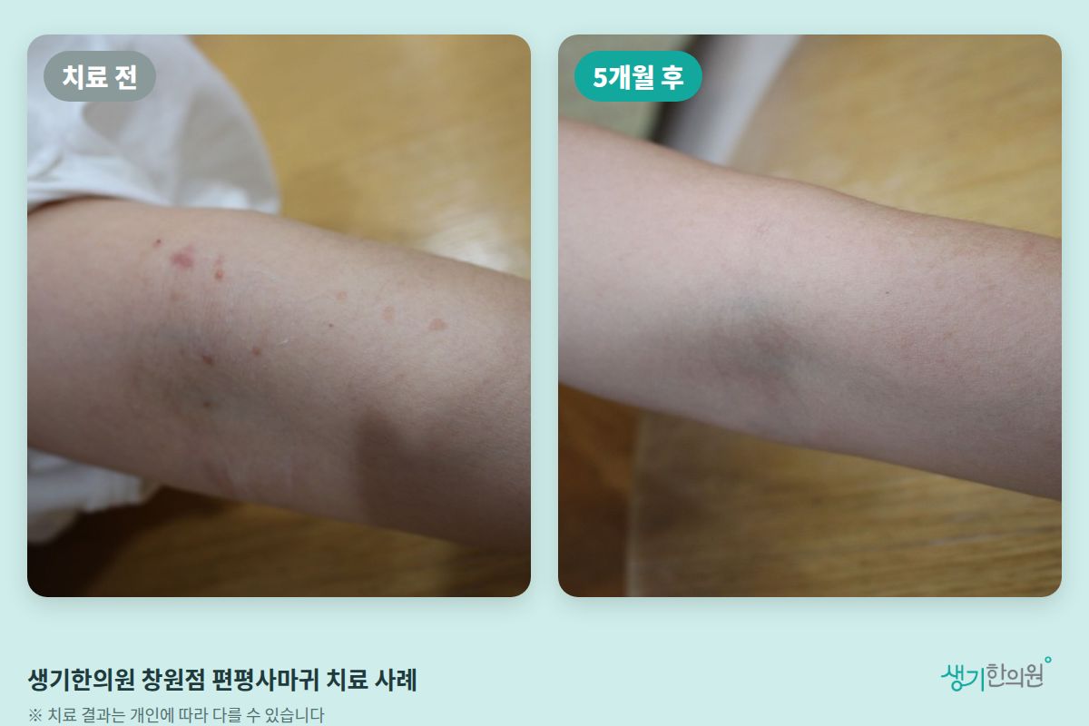 생기한의원 창원점 편평사마귀 치료 전과 5개월 후 비교 사진