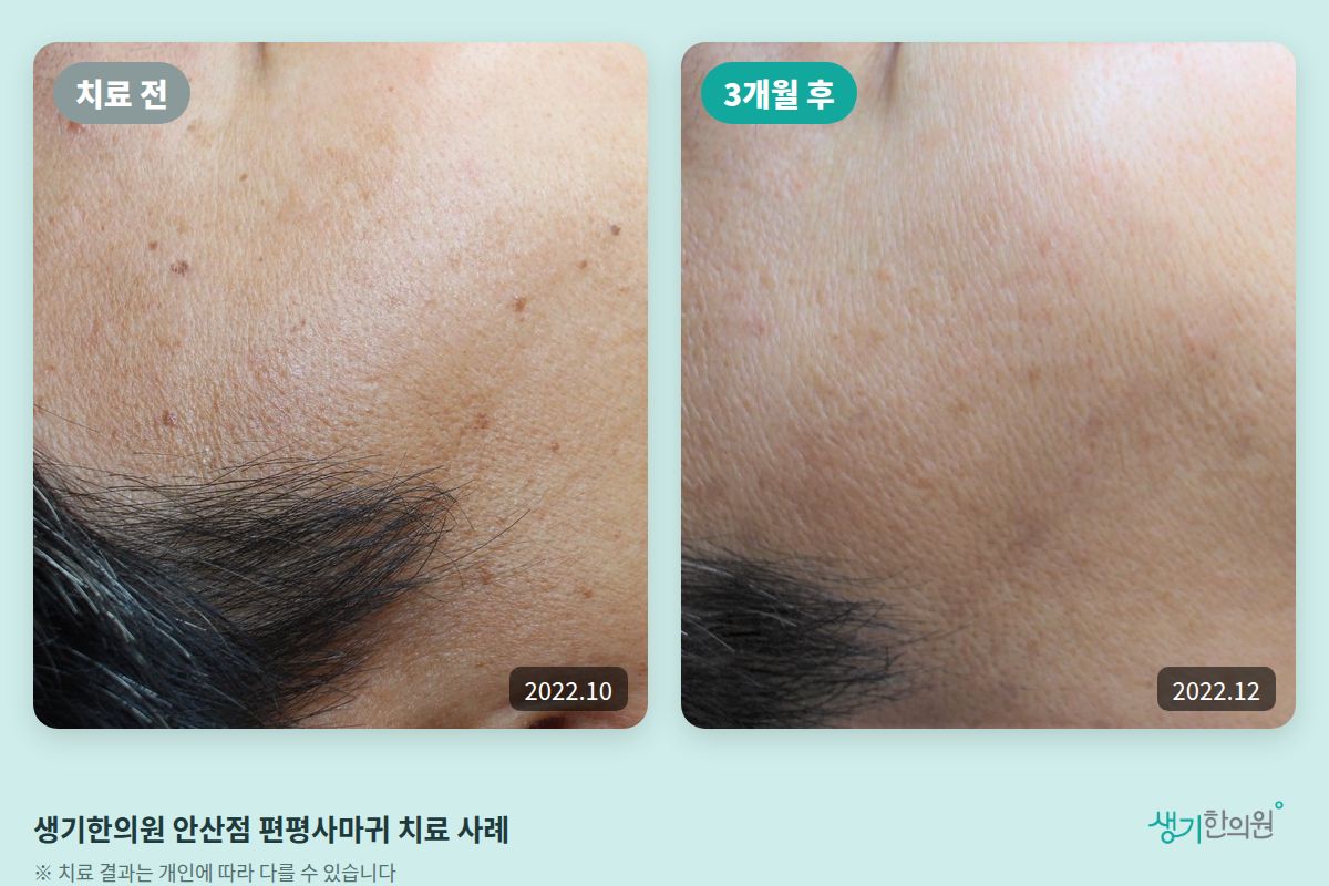 생기한의원 안산점 편평사마귀 치료 전(2022.10)과 3개월 후(2022.12) 비교 사진