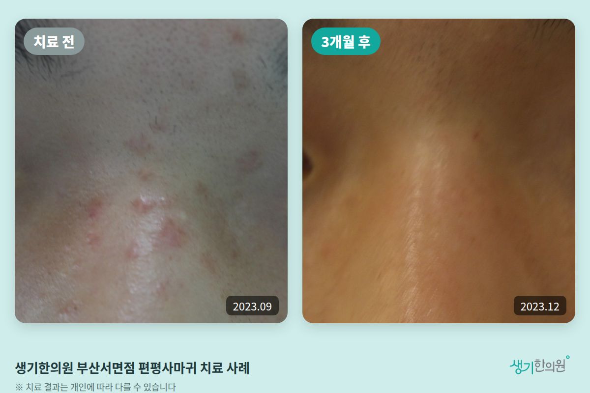 생기한의원 부산서면점 편평사마귀 치료 전(2023.09)과 3개월 후(2023.12) 비교 사진