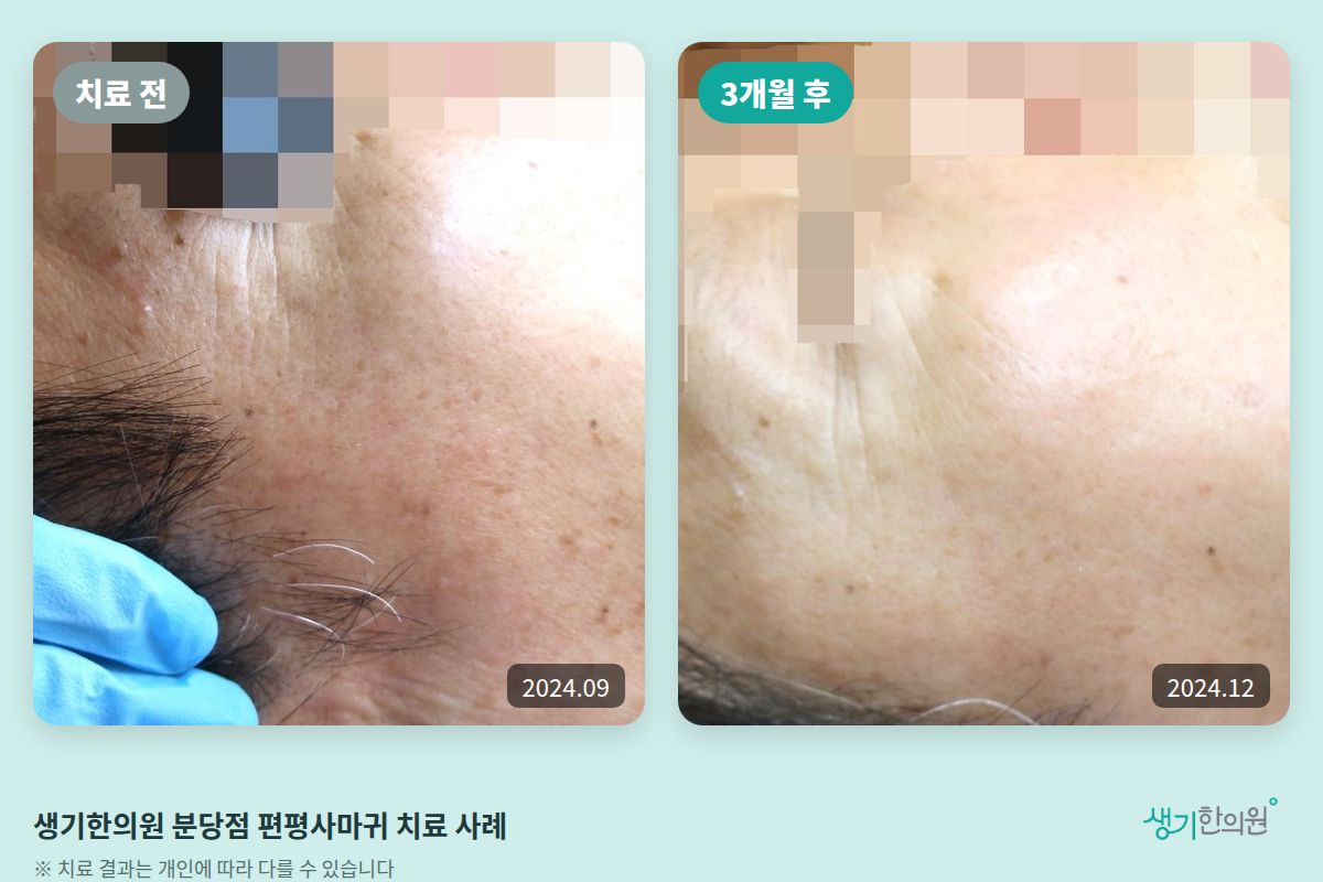 생기한의원 분당점 편평사마귀 치료 전(2024.09)과 3개월 후(2024.12) 이마 비교 사진