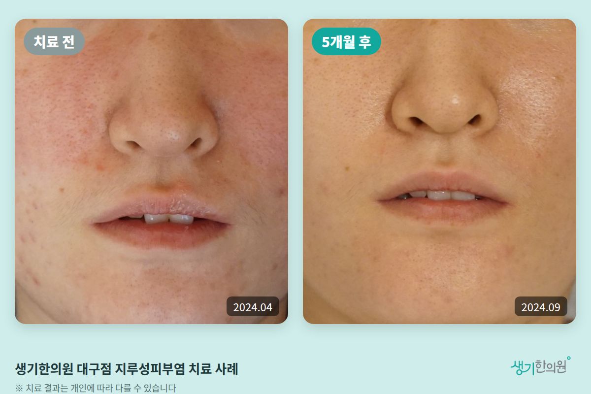 생기한의원 대구점 지루성피부염 치료 전(2024.04)과 5개월 후(2024.09) 비교 사진