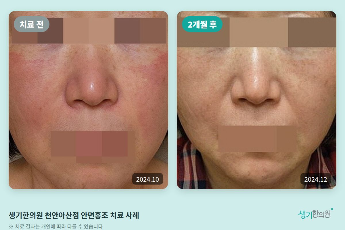 생기한의원 천안아산점 안면홍조 치료 전(2024.10)과 2개월 후(2024.12) 비교 사진