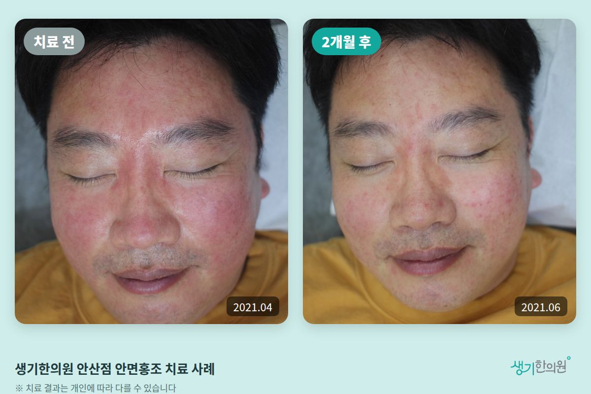 생기한의원 안산점 안면홍조 치료 전(2021.04)과 2개월 후(2021.06) 비교 사진