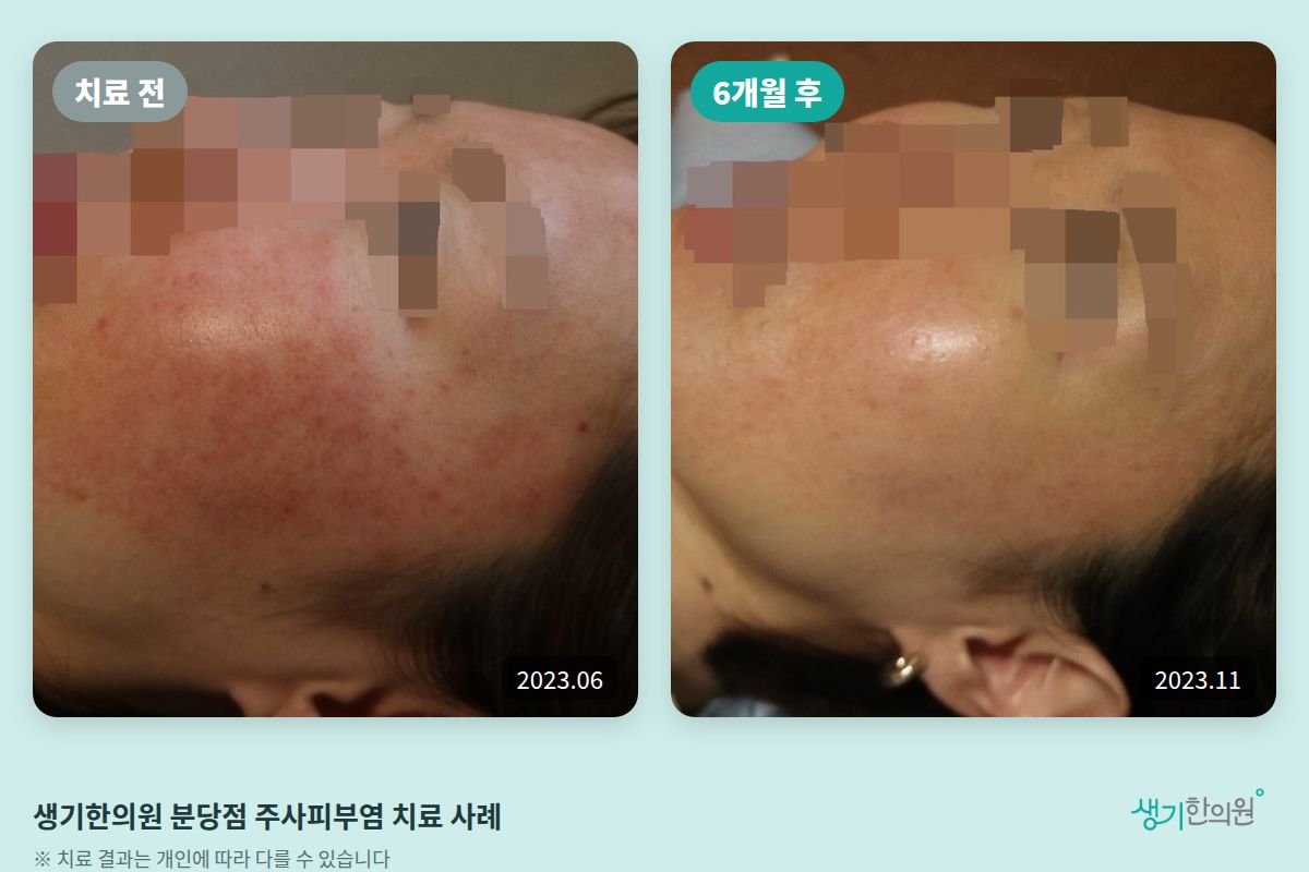 생기한의원 분당점 주사피부염 치료 전(2023.06)과 6개월 후(2023.11) 비교 사진