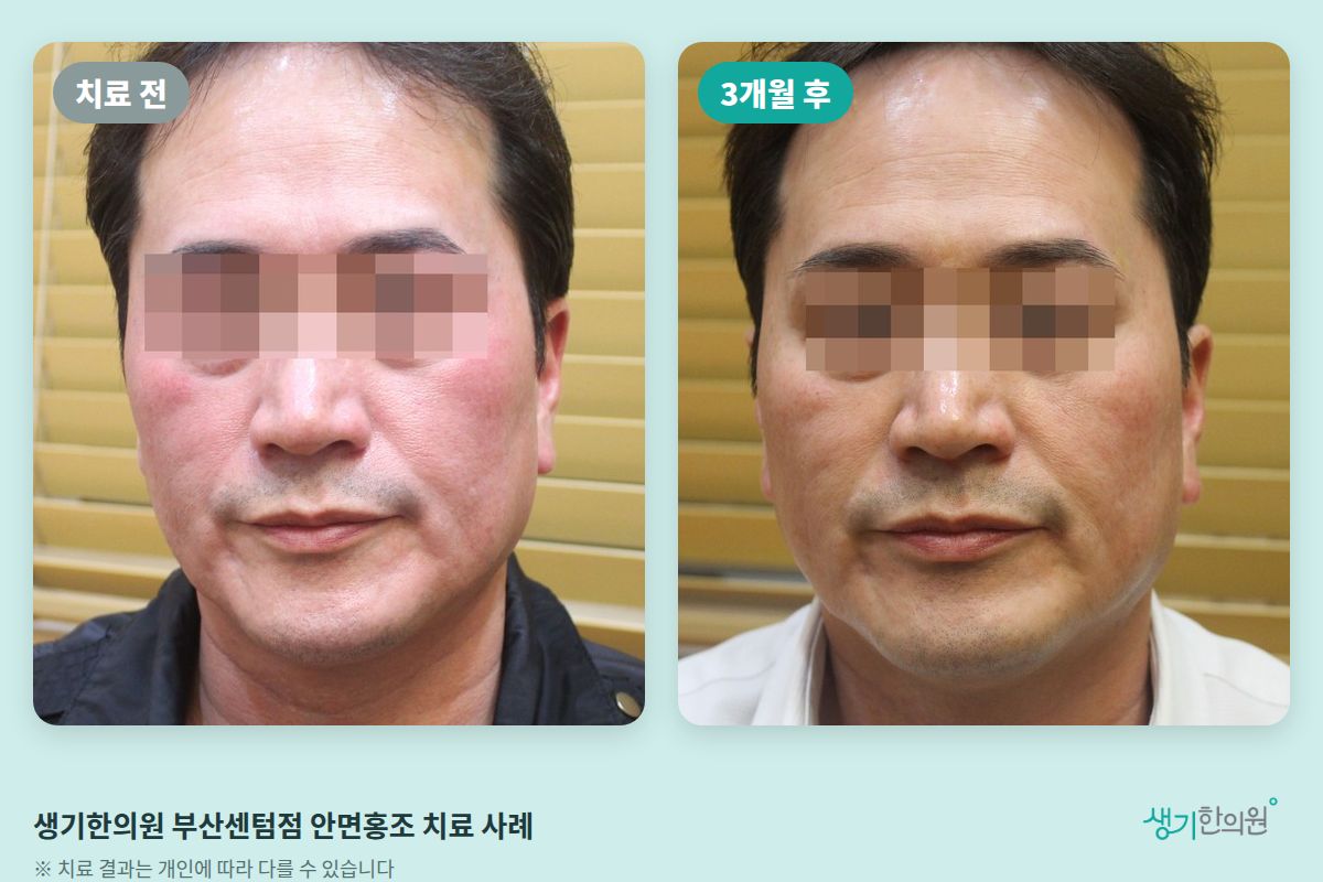생기한의원 부산센텀점 안면홍조 치료 전과 3개월 후 얼굴 비교 사진