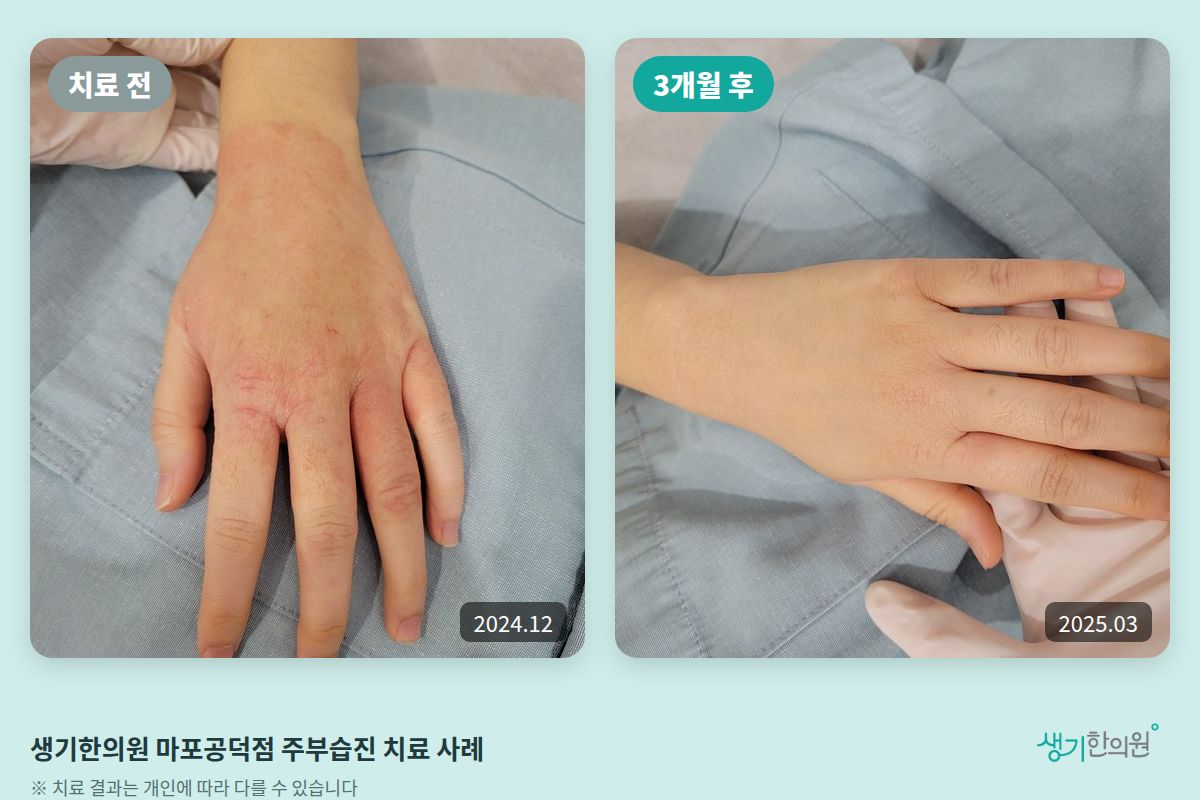 생기한의원 마포공덕점 주부습진 치료 전(2024.12)과 3개월 후(2025.03) 비교 사진