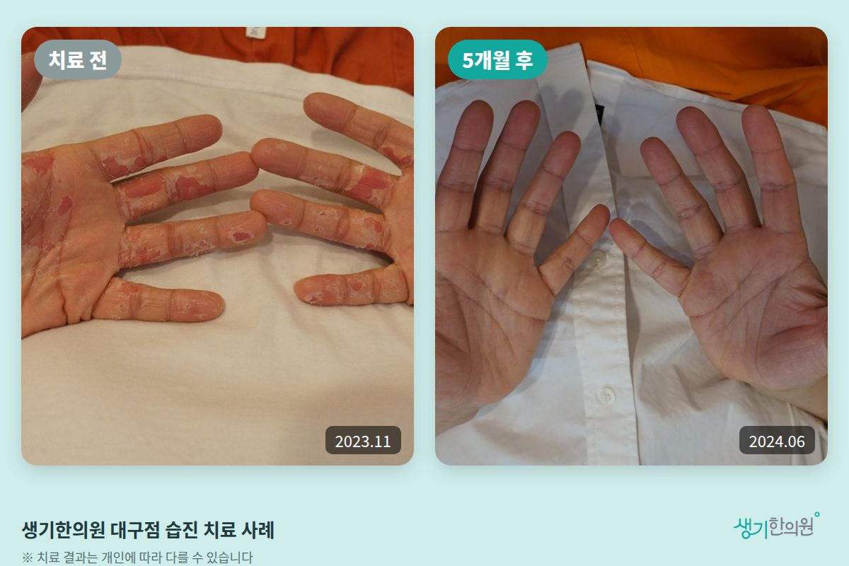 생기한의원 대구점 습진 치료 전(2023.11)과 5개월 후(2024.06) 비교 사진