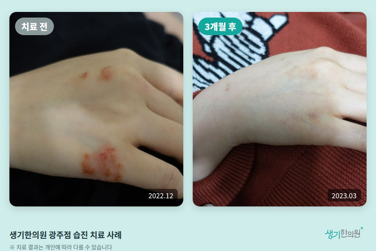 생기한의원 광주점 습진 치료 전(2022.12)과 3개월 후(2023.03) 비교 사진