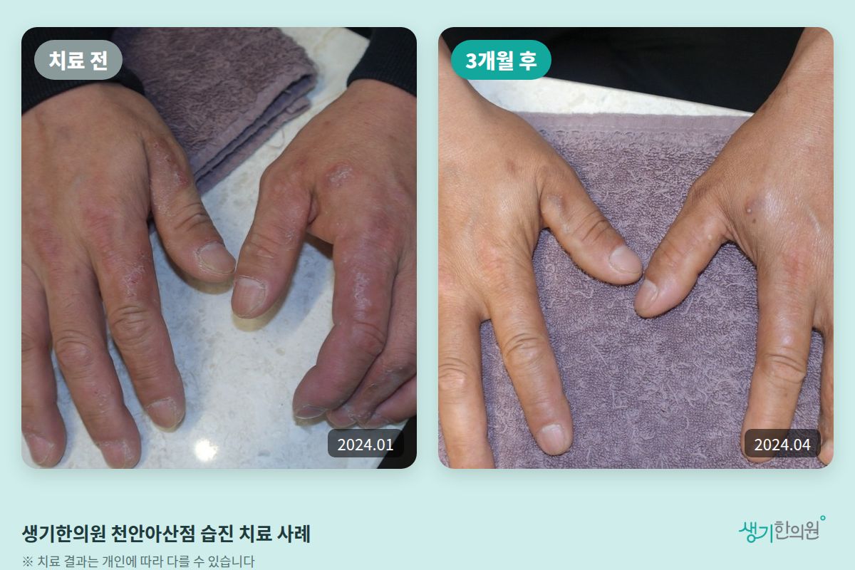 생기한의원 천안아산점 습진 치료 전(2024.01)과 3개월 후(2024.04) 비교 사진