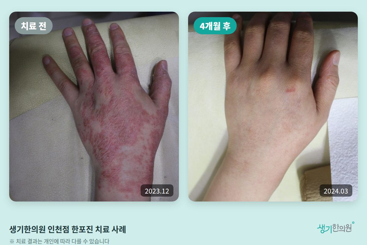 생기한의원 인천점 한포진 치료 전(2023.12)과 4개월 후(2024.03) 비교 사진