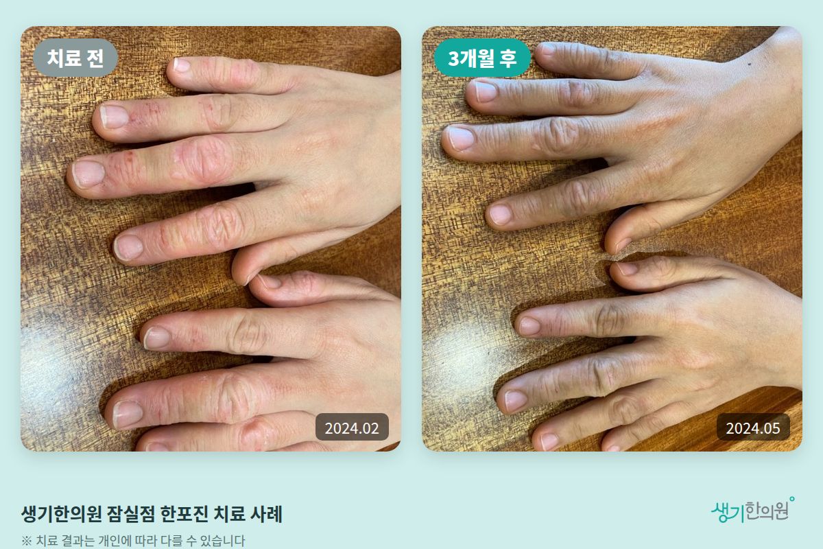 생기한의원 잠실점 한포진 치료 전(2024.02)과 3개월 후(2024.05) 비교 사진