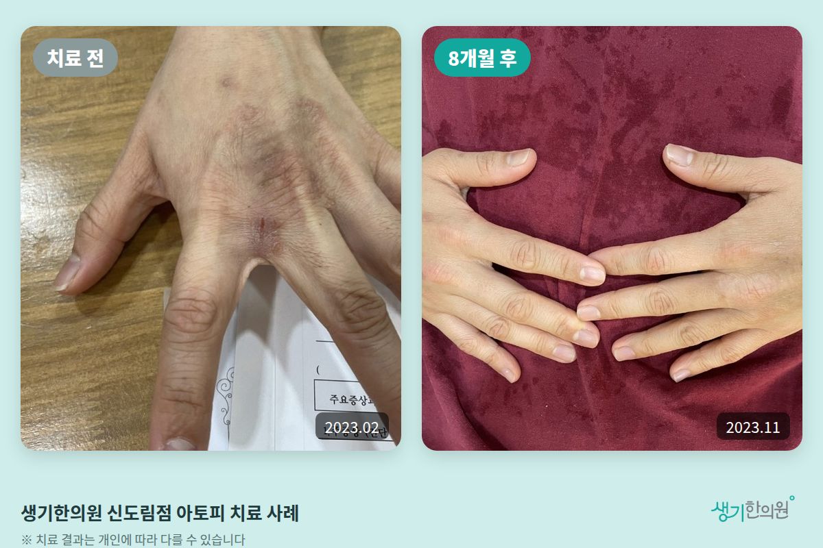 생기한의원 신도림점 아토피 치료 전(2023.02)과 8개월 후(2023.11) 비교 사진
