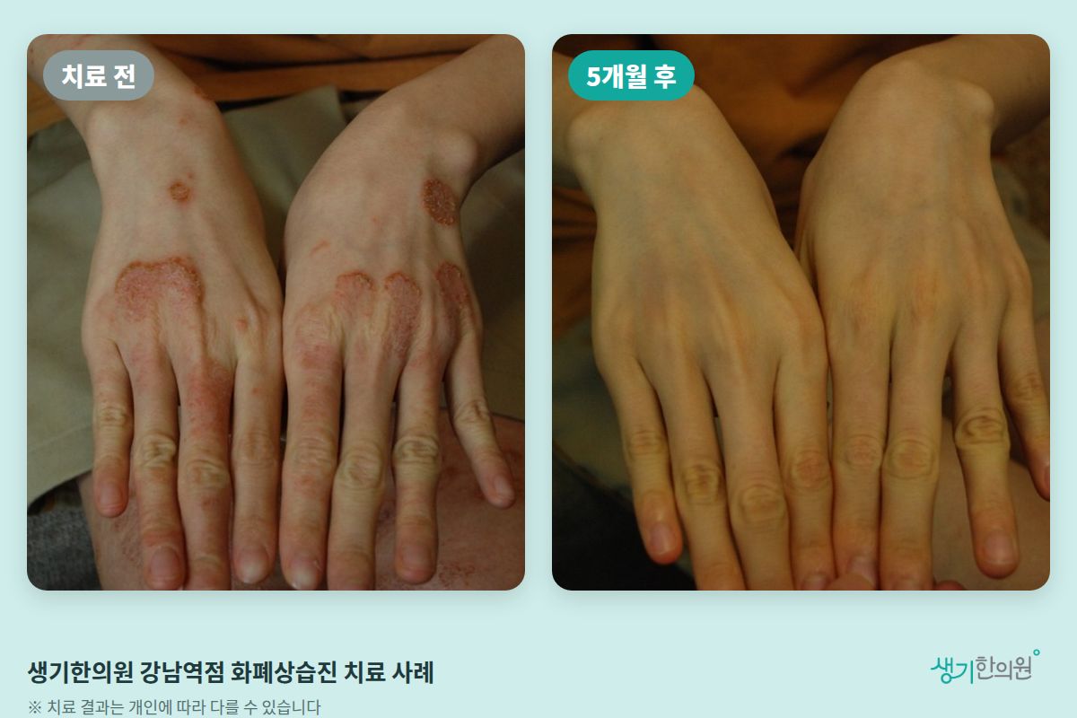 생기한의원 강남역점 화폐상습진 치료 전과 5개월 후 비교 사진