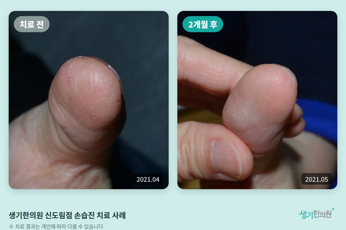 생기한의원 신도림점 손습진 치료 전(2021.04)과 2개월 후(2021.05) 비교 사진