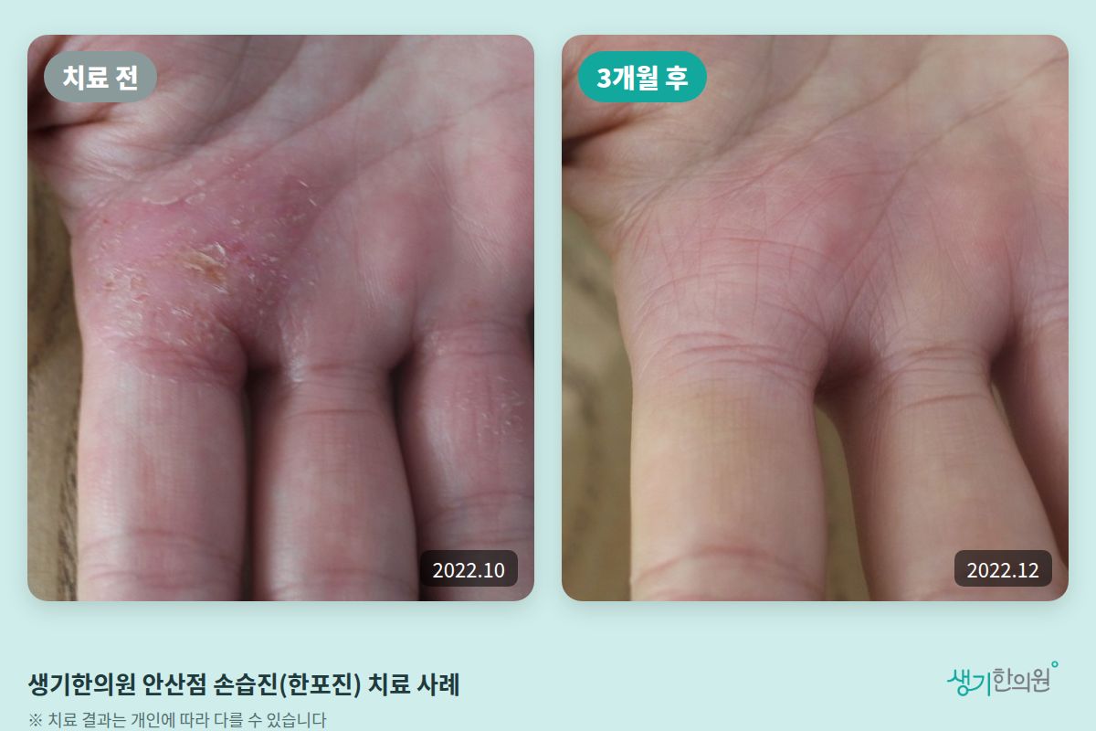 생기한의원 안산점 손습진(한포진) 치료 전(2022.10)과 3개월 후(2022.12) 비교 사진