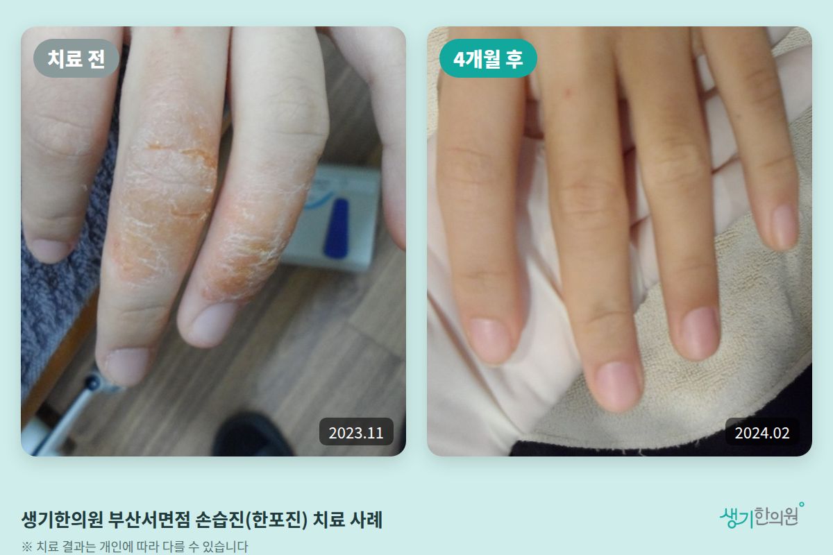 생기한의원 부산서면점 손습진(한포진) 치료 전(2023.11)과 4개월 후(2024.02) 비교 사진