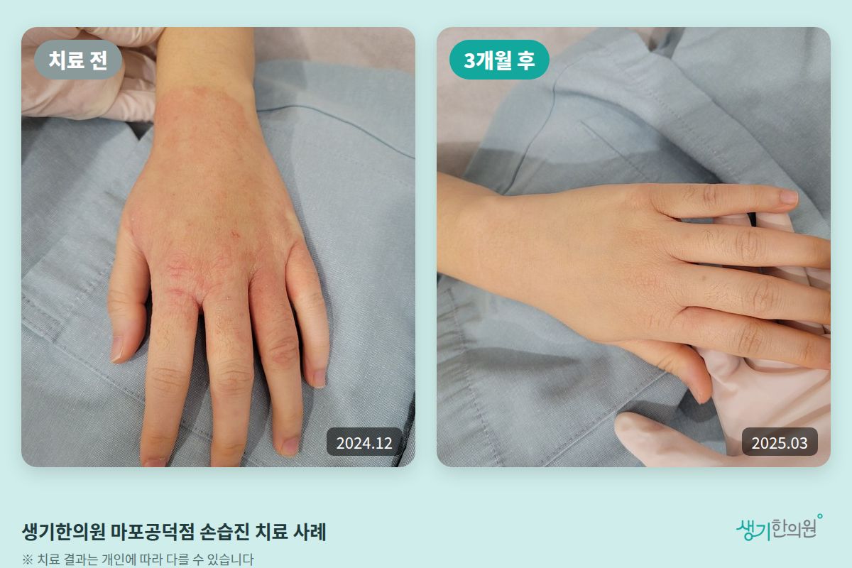 생기한의원 마포공덕점 손습진 치료 전(2024.12)과 3개월 후(2025.03) 비교 사진