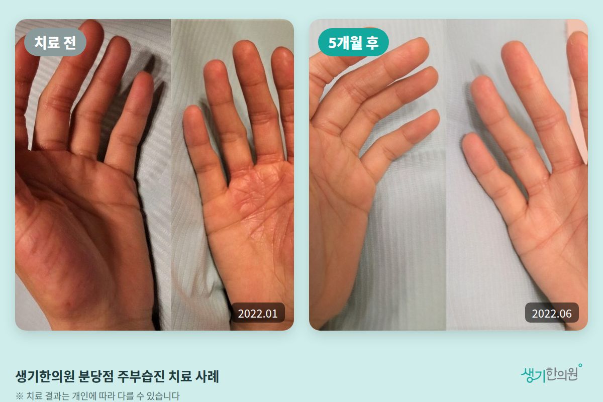생기한의원 분당점 주부습진 치료 전(2022.01)과 5개월 후(2022.06) 손바닥 비교 사진
