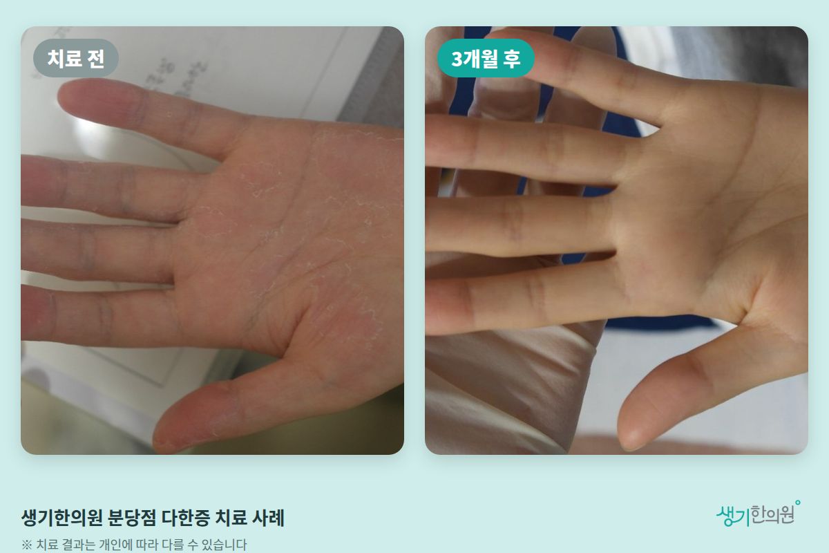 생기한의원 분당점 다한증 치료 전과 3개월 후 비교 사진