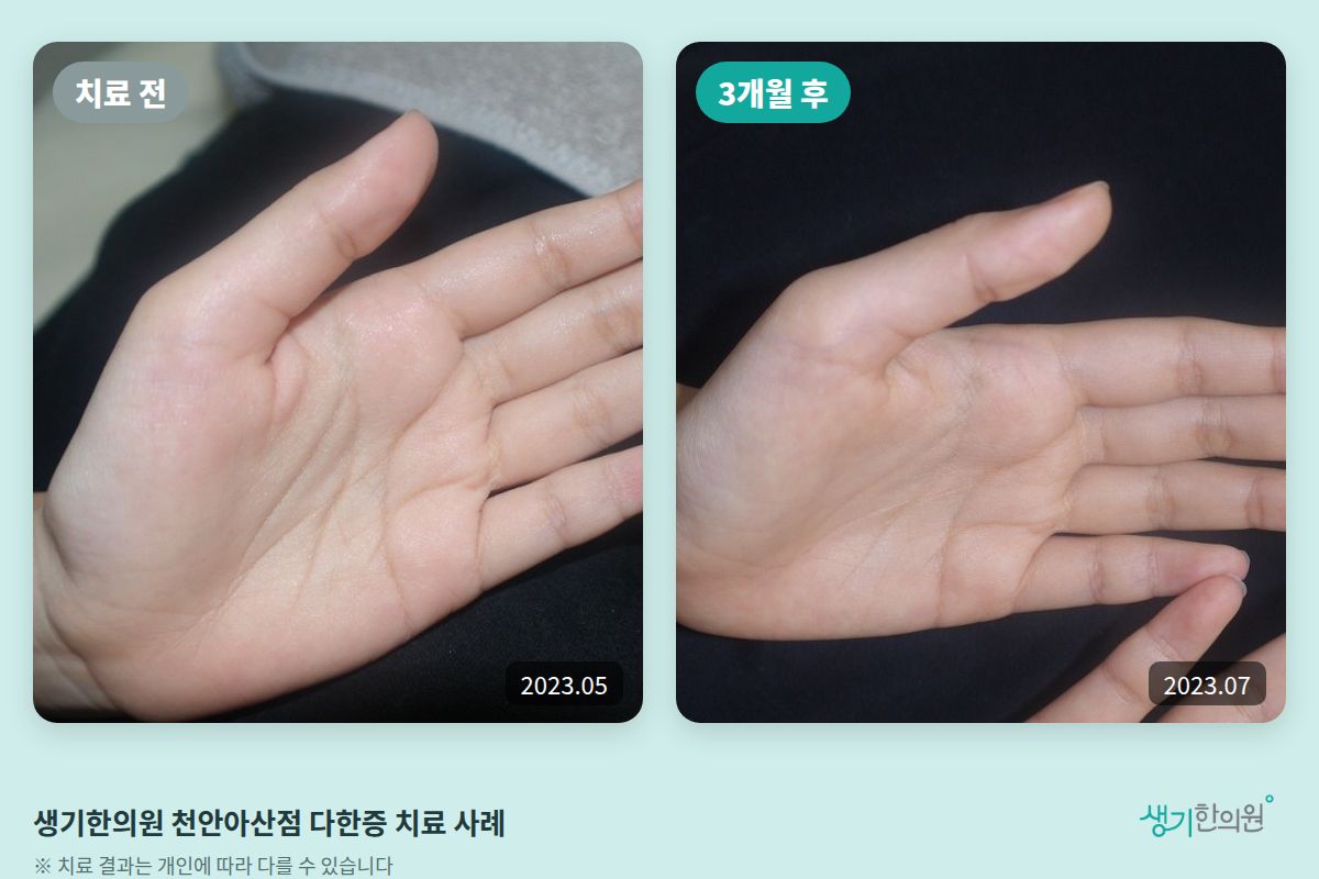 생기한의원 천안아산점 다한증 치료 전(2023.05)과 3개월 후(2023.07) 손바닥 비교 사진