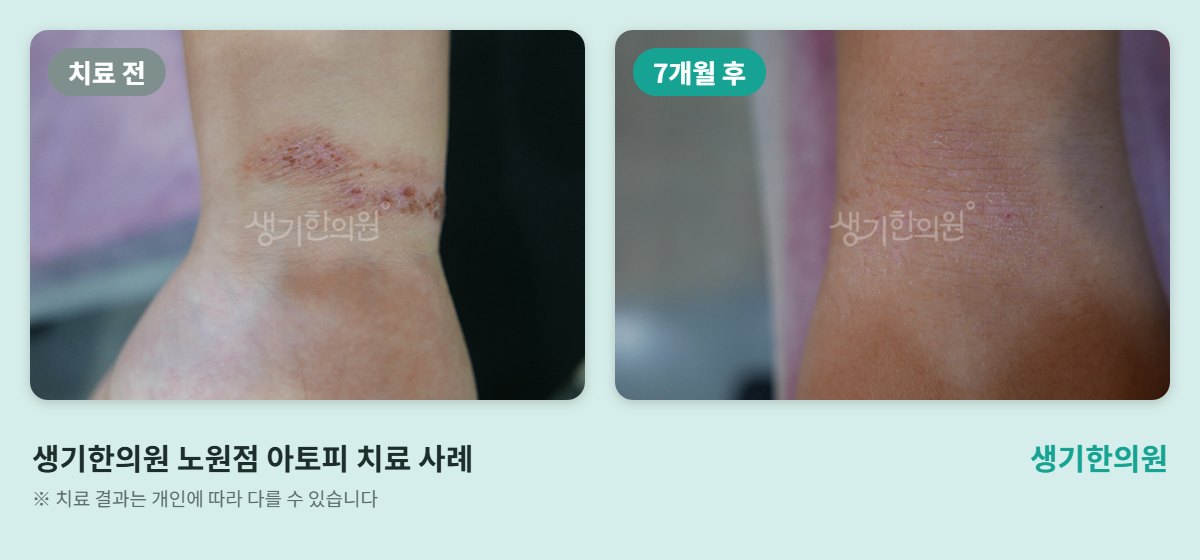 생기한의원 노원점 아토피 치료 전과 7개월 후 손목 비교 사진