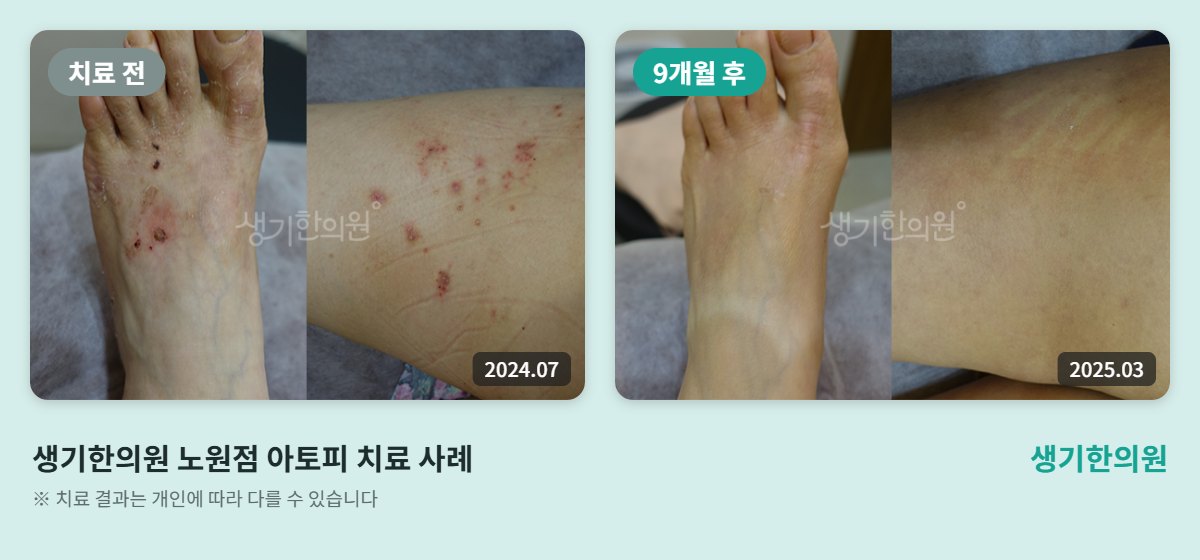 생기한의원 노원점 아토피 치료 전(2024.07)과 9개월 후(2025.03) 무릎 뒤·허벅지 비교 사진