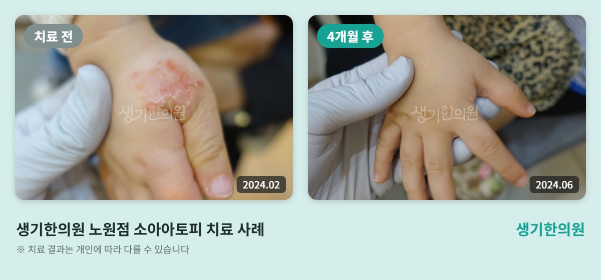 생기한의원 노원점 소아아토피 치료 전(2024.02)과 4개월 후(2024.06) 손 비교 사진