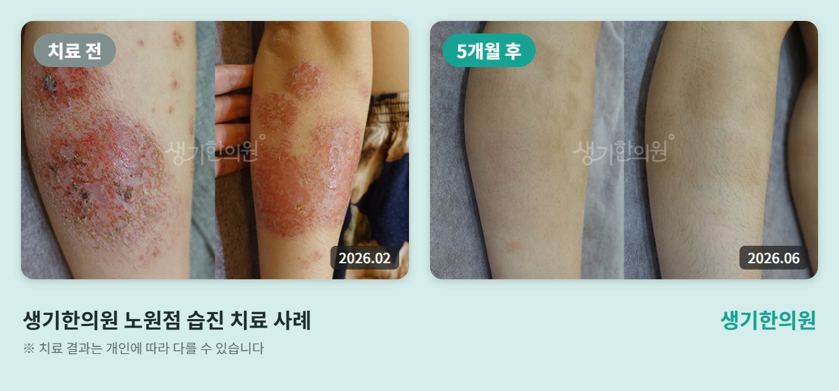생기한의원 노원점 습진 치료 전(2026.02)과 5개월 후(2026.06) 다리 비교 사진