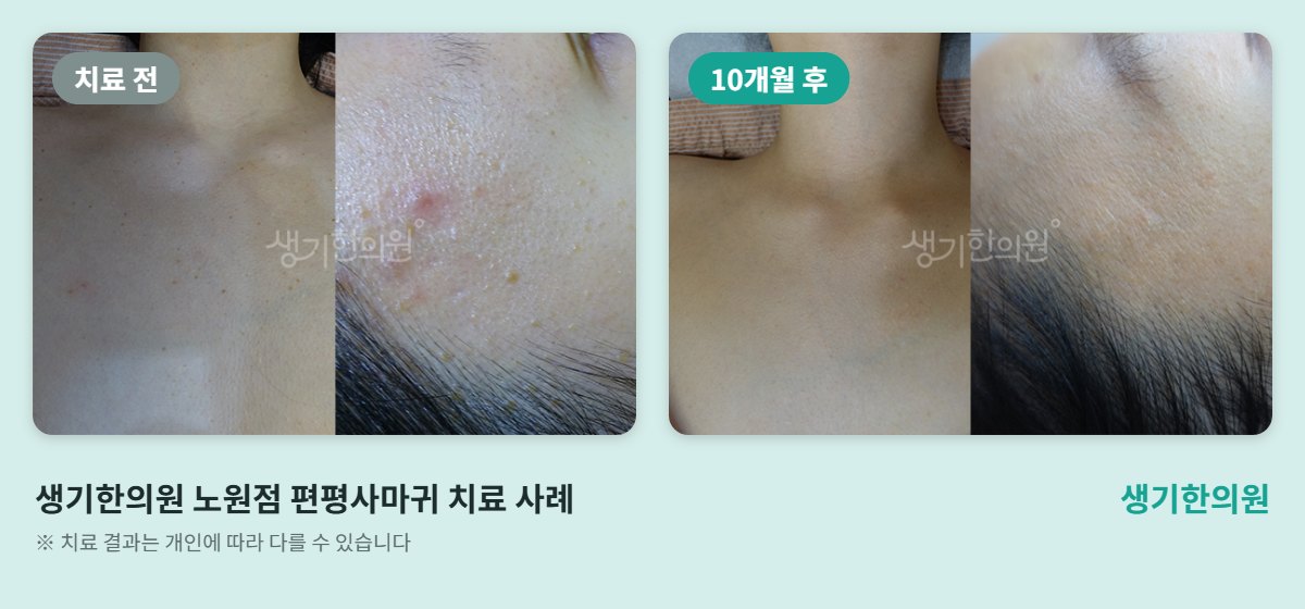 생기한의원 노원점 편평사마귀 치료 전과 10개월 후 목 비교 사진