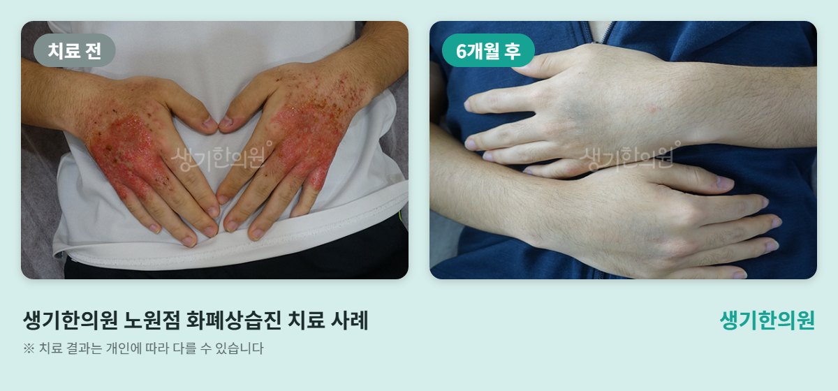 생기한의원 노원점 화폐상습진 치료 전과 6개월 후 손등 비교 사진