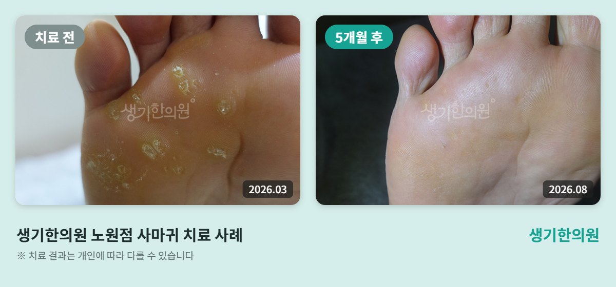 생기한의원 노원점 사마귀 치료 전(2026.03)과 5개월 후(2026.08) 발바닥 비교 사진