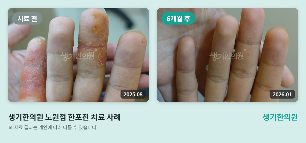 생기한의원 노원점 한포진 치료 전(2025.08)과 6개월 후(2026.01) 손가락 비교 사진