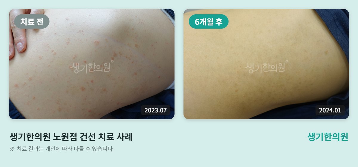 생기한의원 노원점 건선 치료 전(2023.07)과 6개월 후(2024.01) 허벅지 비교 사진