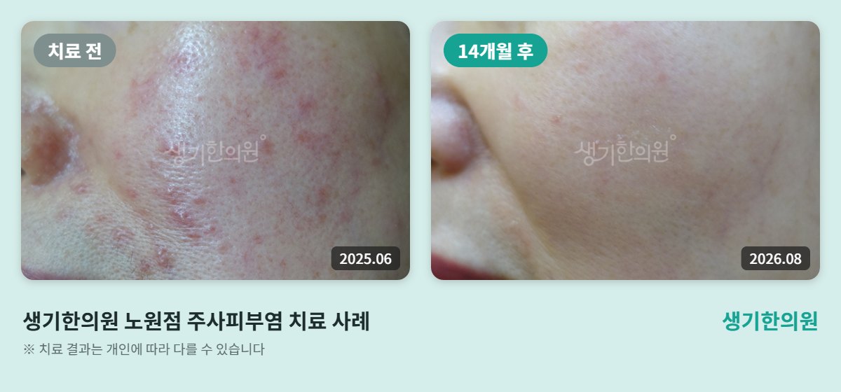 생기한의원 노원점 주사피부염 치료 전(2025.06)과 14개월 후(2026.08) 볼 비교 사진