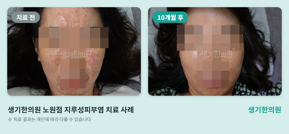 생기한의원 노원점 지루성피부염 치료 전과 10개월 후 얼굴 비교 사진