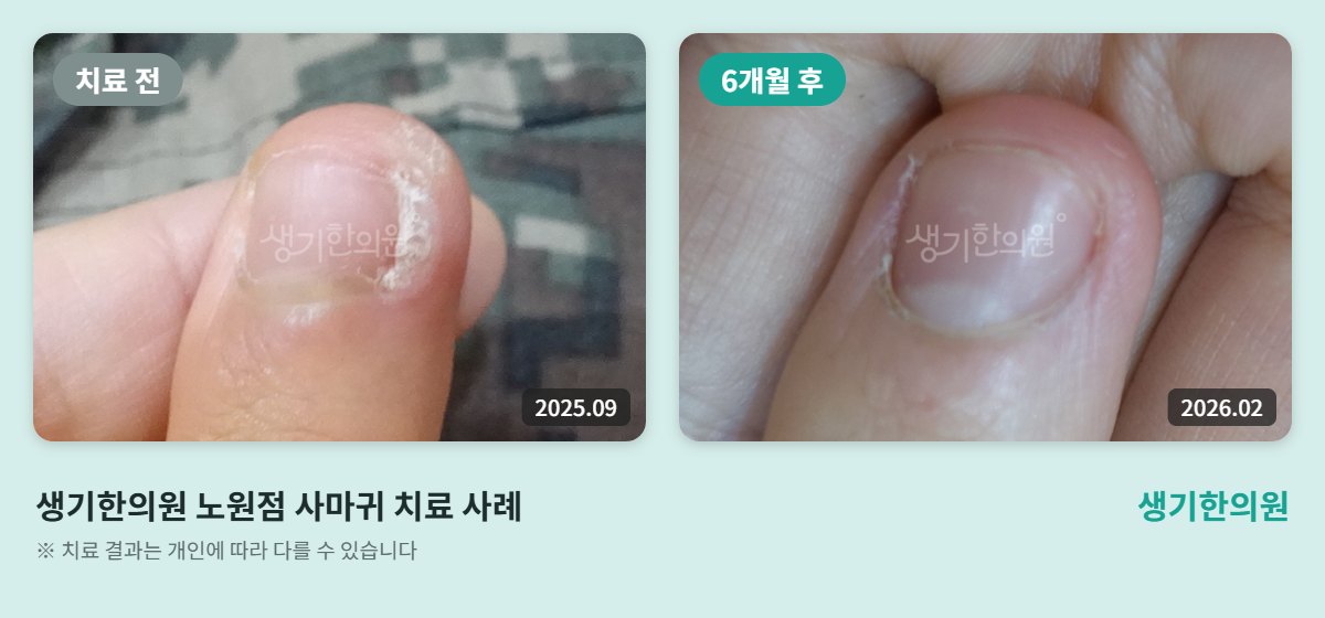 생기한의원 노원점 사마귀 치료 전(2025.09)과 6개월 후(2026.02) 손톱 주위 비교 사진
