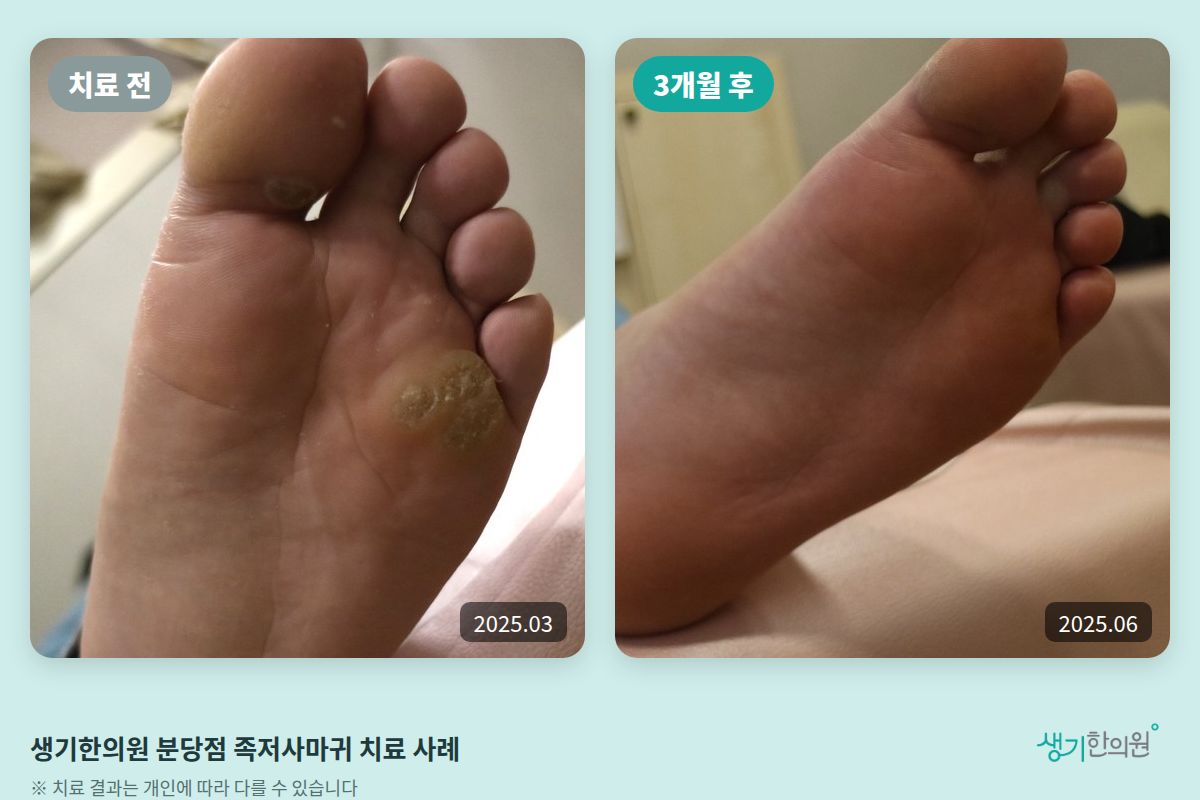 생기한의원 분당점 족저사마귀 치료 전(2025.03)과 3개월 후(2025.06) 비교 사진