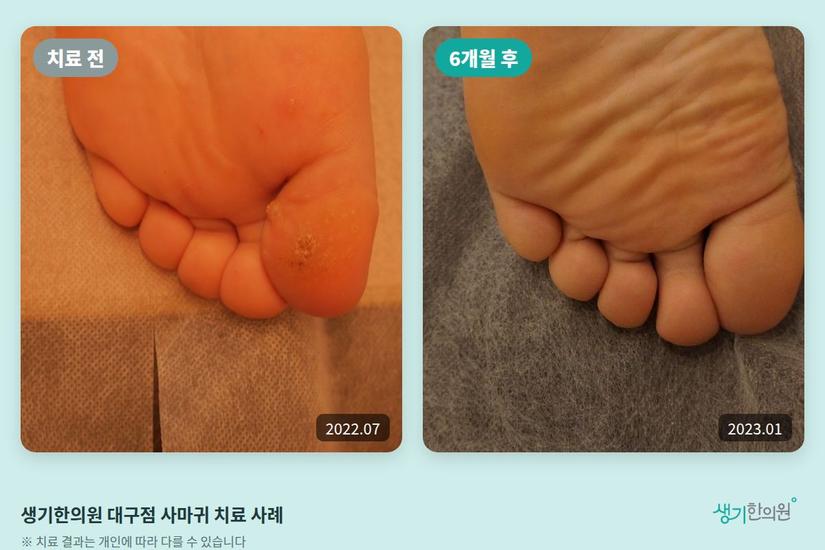생기한의원 대구점 사마귀 치료 전(2022.07)과 6개월 후(2023.01) 비교 사진
