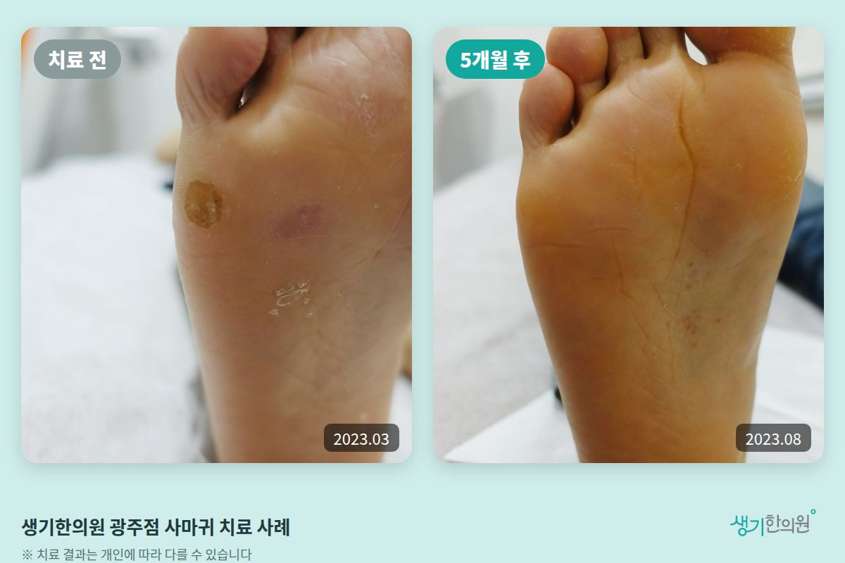 생기한의원 광주점 사마귀 치료 전(2023.03)과 5개월 후(2023.08) 비교 사진
