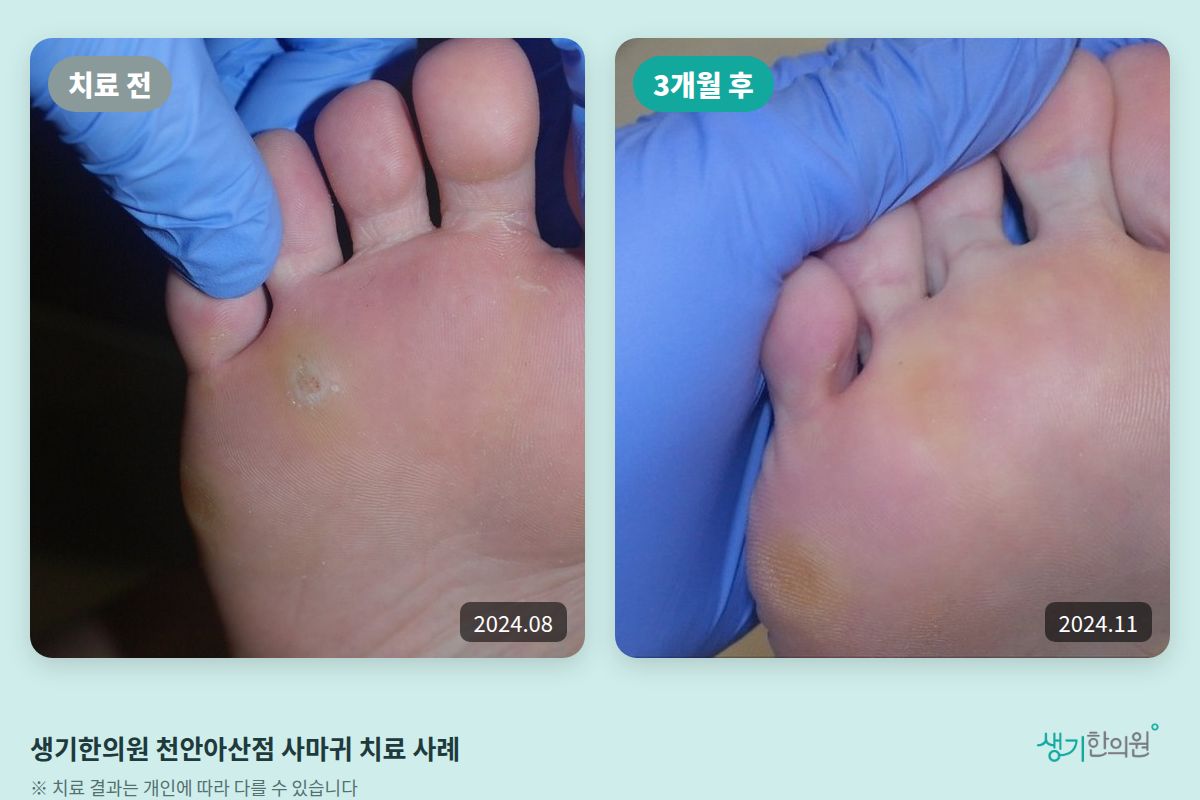 생기한의원 천안아산점 사마귀 치료 전(2024.08)과 3개월 후(2024.11) 비교 사진