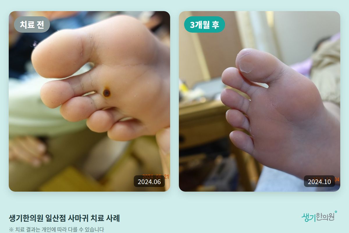 생기한의원 일산점 사마귀 치료 전(2024.06)과 3개월 후(2024.10) 비교 사진