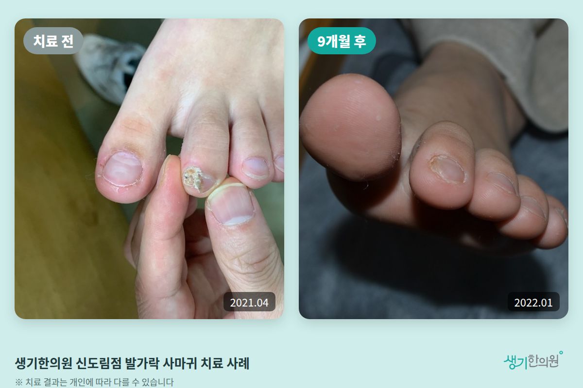 생기한의원 신도림점 발가락 사마귀 치료 전(2021.04)과 9개월 후(2022.01) 비교 사진