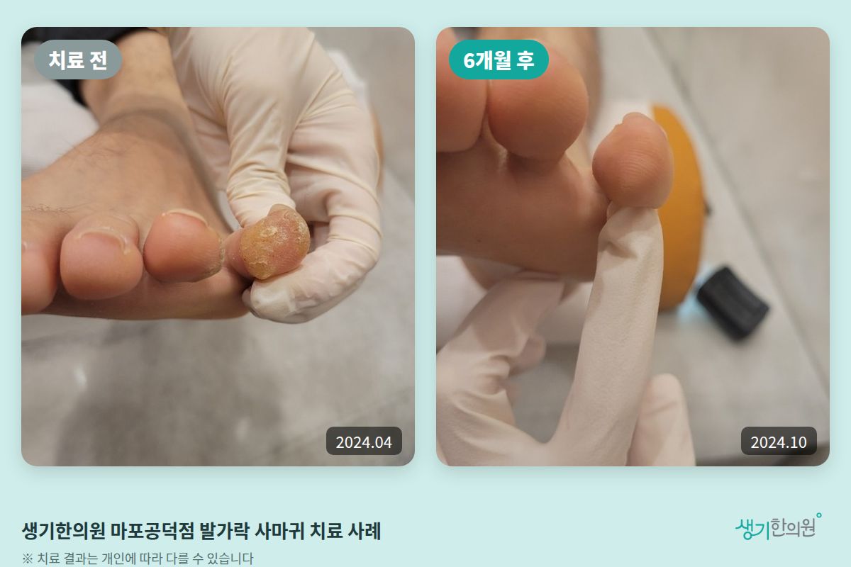 생기한의원 마포공덕점 발가락 사마귀 치료 전(2024.04)과 6개월 후(2024.10) 비교 사진