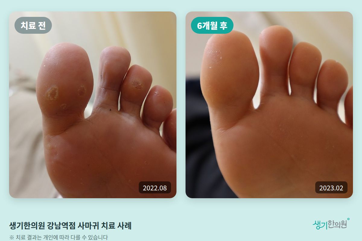 생기한의원 강남역점 사마귀 치료 전(2022.08)과 6개월 후(2023.02) 비교 사진