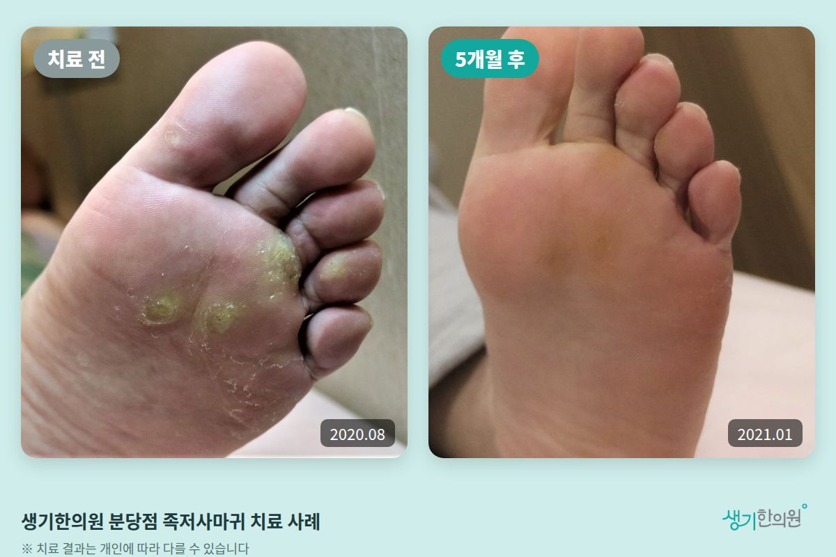 생기한의원 분당점 족저사마귀 치료 전(2020.08)과 5개월 후(2021.01) 비교 사진