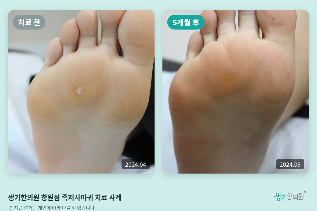 생기한의원 창원점 족저사마귀 치료 전(2024.04)과 5개월 후(2024.09) 비교 사진