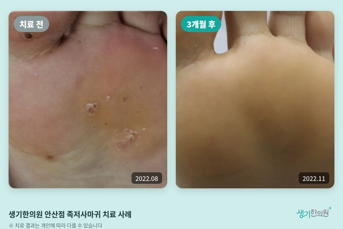 생기한의원 안산점 족저사마귀 치료 전(2022.08)과 3개월 후(2022.11) 비교 사진