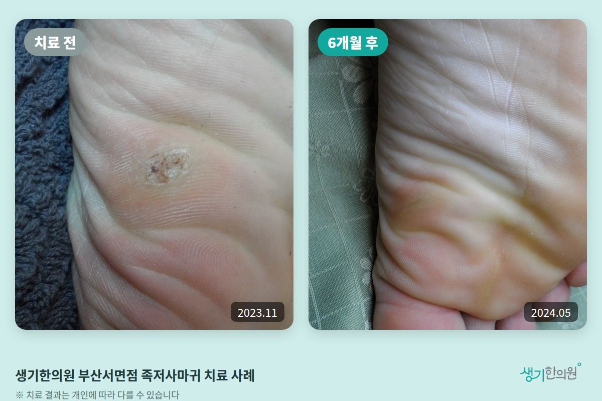 생기한의원 부산서면점 족저사마귀 치료 전(2023.11)과 6개월 후(2024.05) 비교 사진